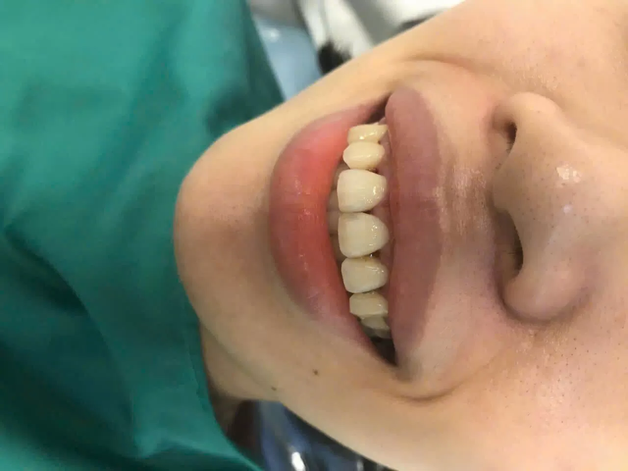 ĐIỀU TRỊ CƯỜI HỞ LỢI, KÉO DÀI THÂN RĂNG