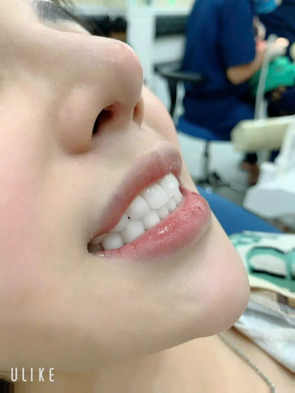 THẨM MĨ, BỌC RĂNG SỨ