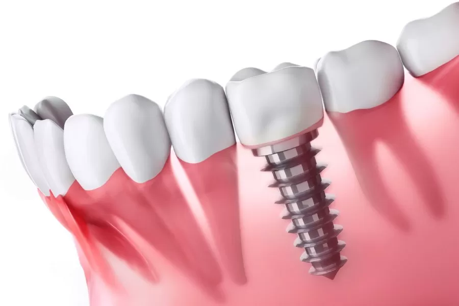 Ghép xương cấy implant có đau không? 5 điều bạn nên biết