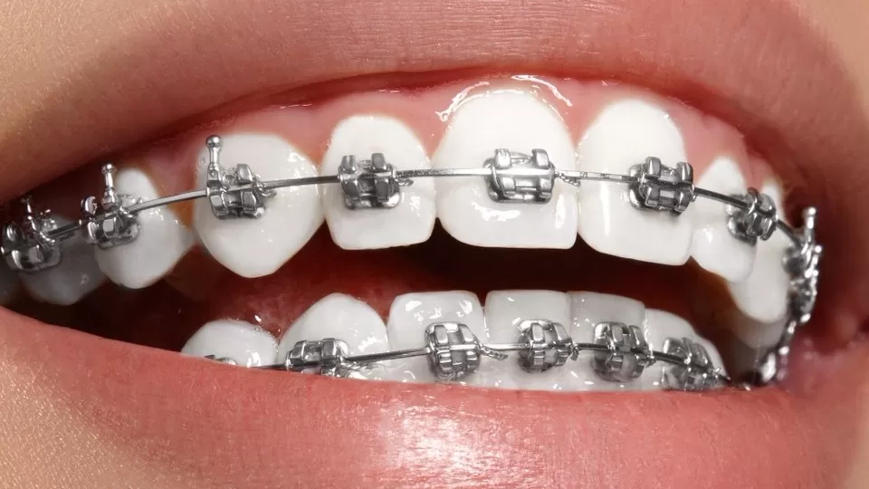 Tại sao nên chỉnh nha với hệ thống mắc cài Damon? 5 lợi ích vượt trội bạn không nên bỏ lỡ